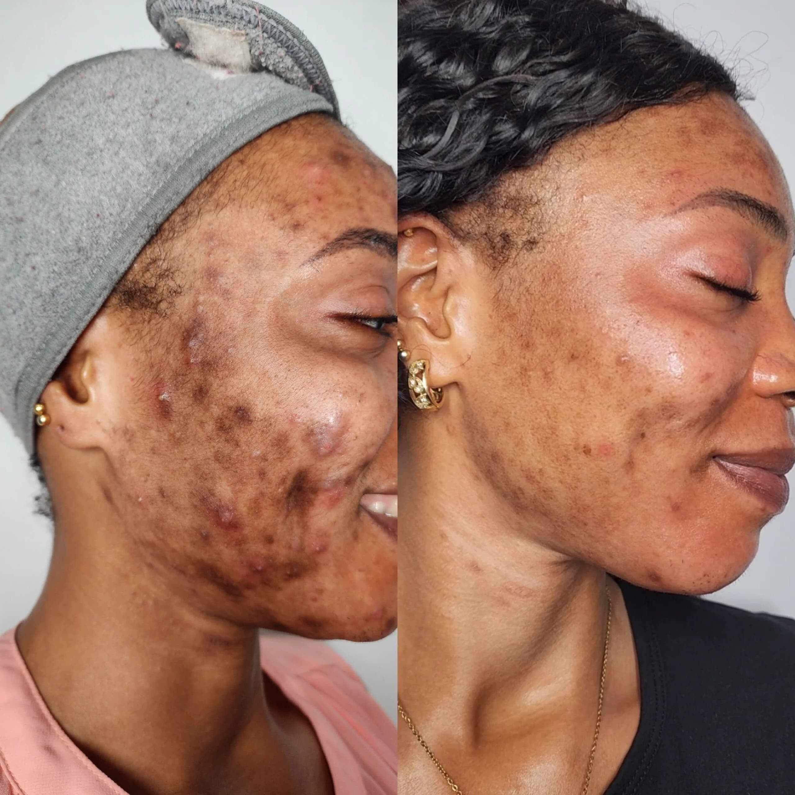 Moles Remover cover image