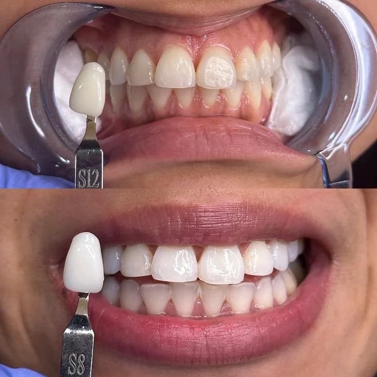 Teeth Whitening cover image